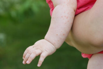 romania a avut peste 1 000 de cazuri de rujeola in luna mai judetul cu cele mai multe imbolnaviri 683ffc89515e3