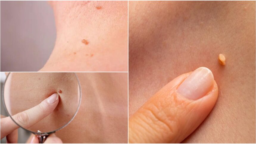 ce sunt papiloamele si cat de periculoase pot fi iata cum poti scapa de ele 68c9b3a89c441
