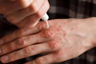 alerta in romania a fost confirmat primul caz de lepra din ultimii 44 de ani alte trei suspiciuni sunt in analiza 693b1a6c6e7b8