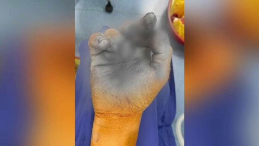 incident in braila doi copii raniti in urma exploziei unei petarde 6941079117ed0