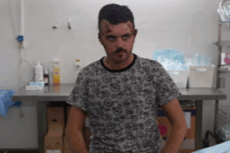 un pacient din barlad cu arsuri la nivelul bratelor gatului si capului spune ca s a nascut a doua oara la spitalul slatina foto 6989f2a47de2f