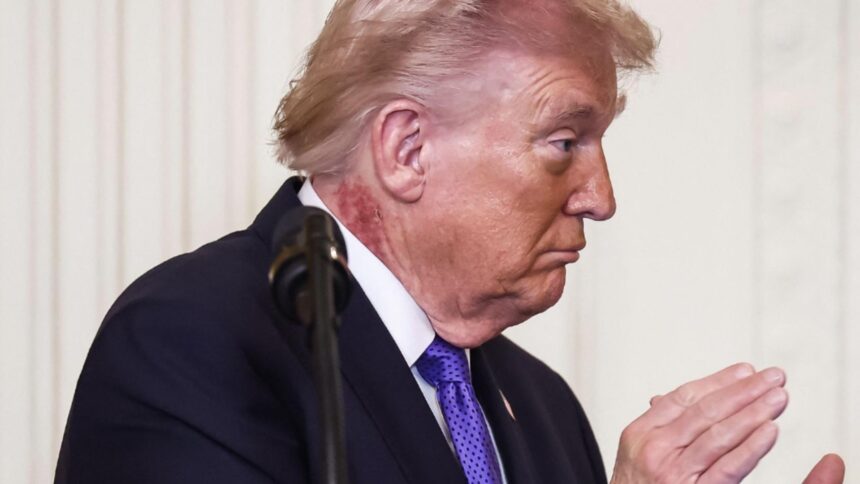 misterul petei rosii a lui trump descifrat de medici cat timp va purta liderul american semnele iritatiei de pe gat 69a60700d69fb